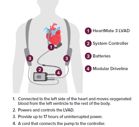 A graphic of an LVAD device
